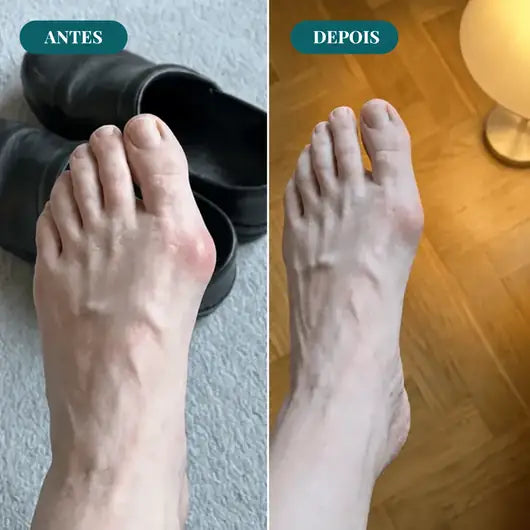 Corretor EMS para Joanetes